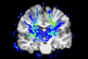 brain with parkinson