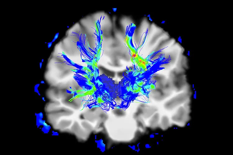 brain with parkinson