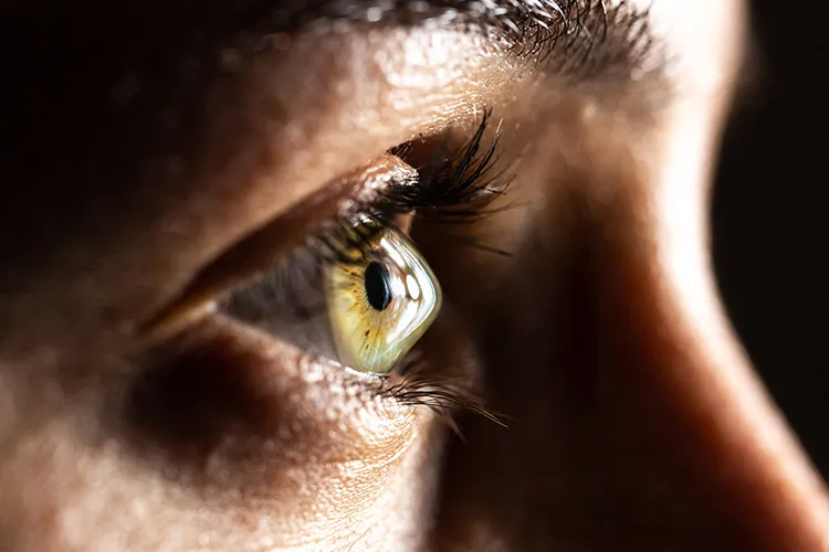 photo of a cornea affected by keratoconus