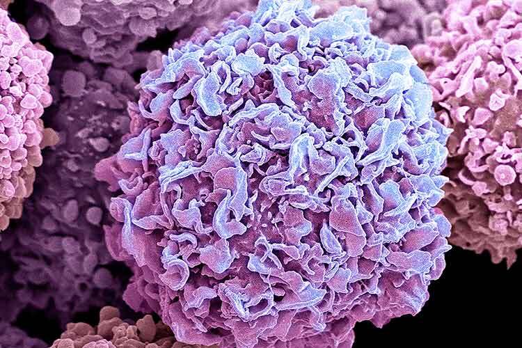 Breast Cancer Cells