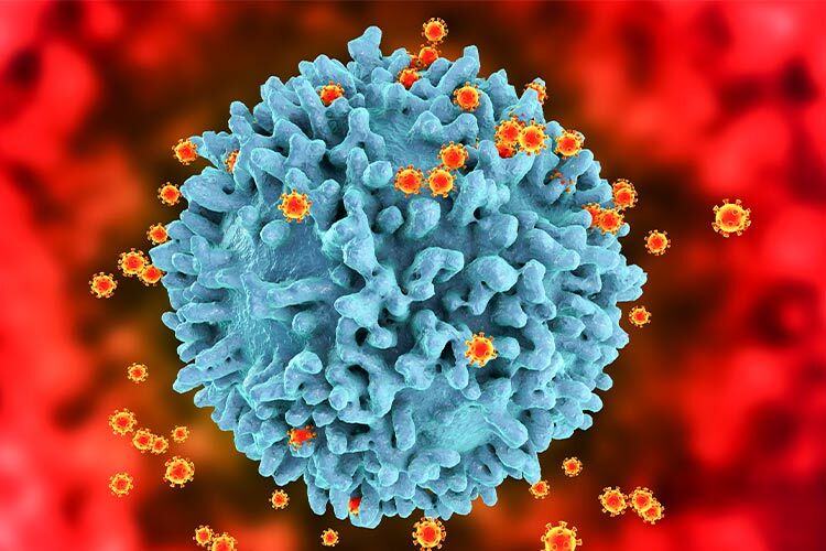 HIV viruses infecting T-lymphocytes, computer illustration. The surface of the T-cell has a lumpy appearance with large irregular surface protrusions. Smaller spherical structures on the cell surface are HIV virus particles budding away from the cell membrane