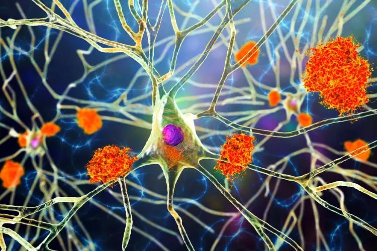 Illustration of amyloid plaques accumulated between neurons, one of the main hallmarks of Alzheimer's disease. Excess amyloid plaques disrupt neuronal communication and lead to loss of connections.