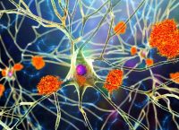 Illustration of amyloid plaques accumulated between neurons, one of the main hallmarks of Alzheimer's disease. Excess amyloid plaques disrupt neuronal communication and lead to loss of connections.