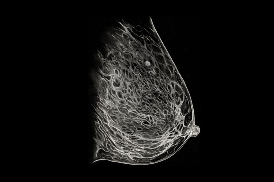 Black and white illustration of a mammography