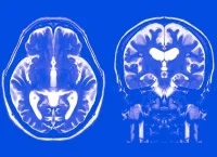 image of an mri at the brain