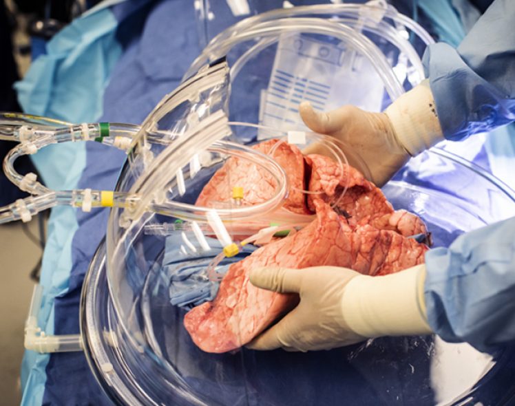 image of a lung being transplant
