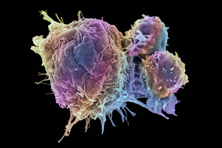 Linfocitos T y células cancerosas. Micrografía electrónica de barrido a color (SEM) de células de linfocitos T (células redondas más pequeñas) adheridas a una célula cancerosa.