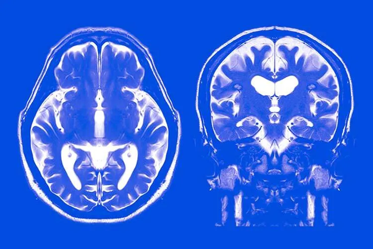 imagen de un cerebro