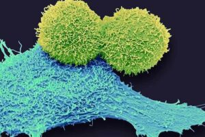 Imagen microscopica de células tumorales de cáncer de mama