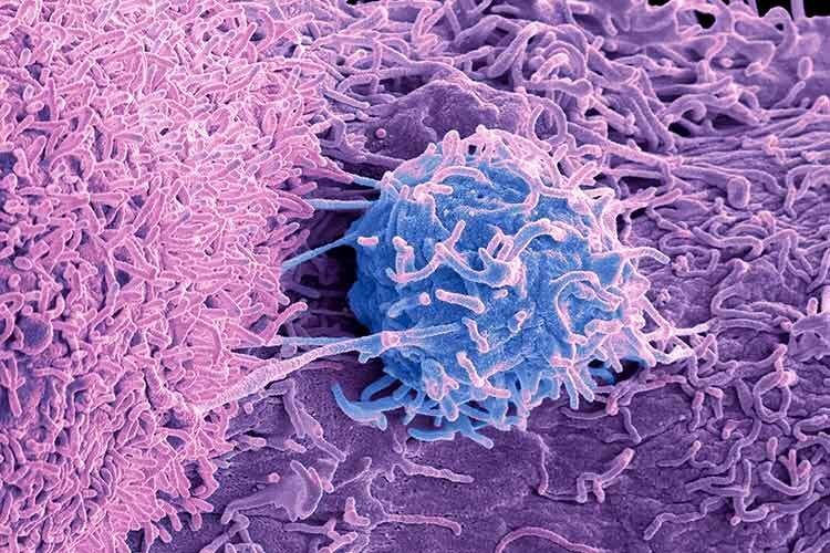 Imagen de una célula cancerígena de próstata