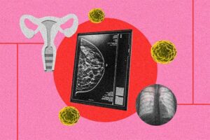 Fotoarte enelque se ve una pantalla con la radiografía de un seno y a la izquierda ilustración de trompas de falopio y a la derecha una radiografía de pulmones