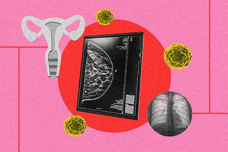 Fotoarte enelque se ve una pantalla con la radiografía de un seno y a la izquierda ilustración de trompas de falopio y a la derecha una radiografía de pulmones