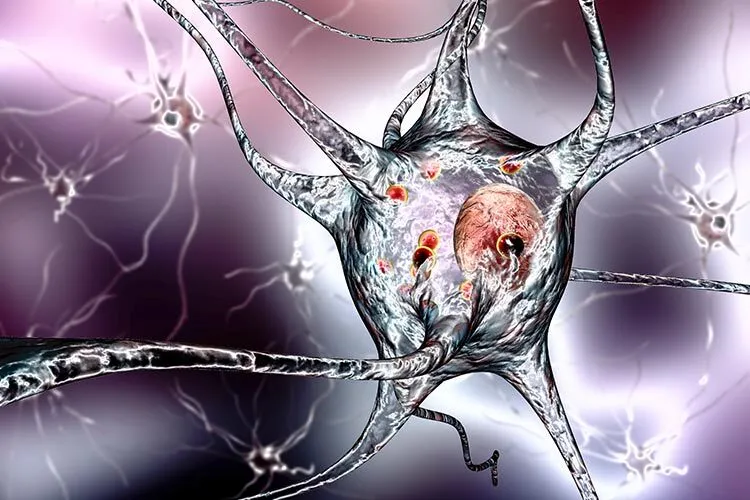 Ilustración de neuronas afectadas por la enfermedad de Parkinson y sus cambios neurológicos.