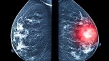 Una mastografía comparativa: del lado derecho se resalta una masa sospechosa, el tipo de hallazgo que sistemas como ALIA Health buscan detectar de forma más temprana mediante inteligencia artificial. (Imagen: Getty Images)