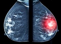 Una mastografía comparativa: del lado derecho se resalta una masa sospechosa, el tipo de hallazgo que sistemas como ALIA Health buscan detectar de forma más temprana mediante inteligencia artificial. (Imagen: Getty Images)