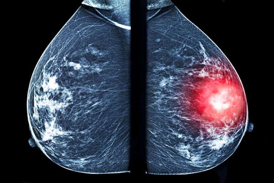 Una mastografía comparativa: del lado derecho se resalta una masa sospechosa, el tipo de hallazgo que sistemas como ALIA Health buscan detectar de forma más temprana mediante inteligencia artificial. (Imagen: Getty Images)