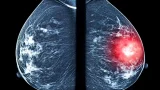 Una mastografía comparativa: del lado derecho se resalta una masa sospechosa, el tipo de hallazgo que sistemas como ALIA Health buscan detectar de forma más temprana mediante inteligencia artificial. (Imagen: Getty Images)