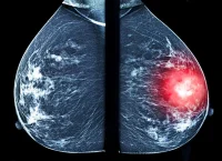 Una mastografía comparativa: del lado derecho se resalta una masa sospechosa, el tipo de hallazgo que sistemas como ALIA Health buscan detectar de forma más temprana mediante inteligencia artificial. (Imagen: Getty Images)