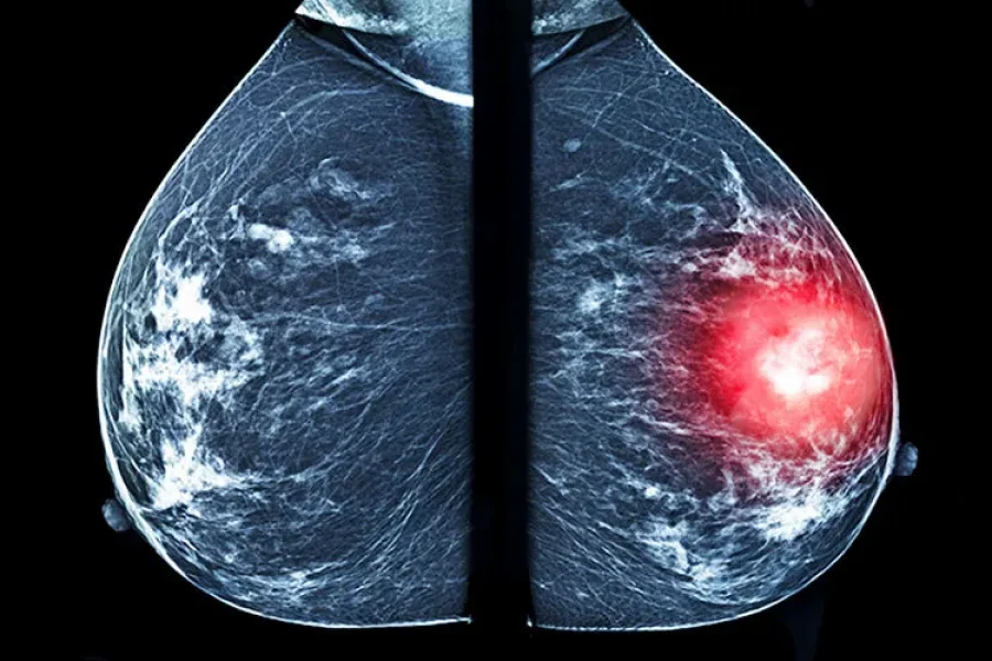 Una mastografía comparativa: del lado derecho se resalta una masa sospechosa, el tipo de hallazgo que sistemas como ALIA Health buscan detectar de forma más temprana mediante inteligencia artificial. (Imagen: Getty Images)
