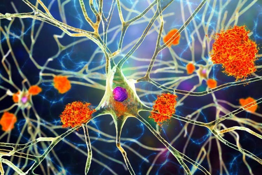 imagen del las placas amiloides