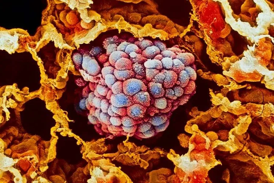 El conocimiento sobre la biología de los tumores ha permitido el desarrollo de terapias dirigidas que actúan sobre las células cancerosas. (Foto: Getty Images)