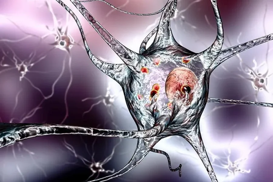 Ilustración de neuronas afectadas por la enfermedad de Parkinson y sus cambios neurológicos.