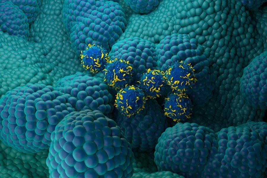 Ilustración que muestra el uso de células T con receptor de antígeno quimérico (CAR) (azul y amarillo) para tratar el cáncer de próstata (azul claro, nodular). (Ilustración: Getty Images)